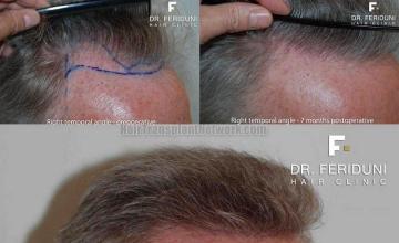 Top views displaying Follicular Unit Extraction hair restoration