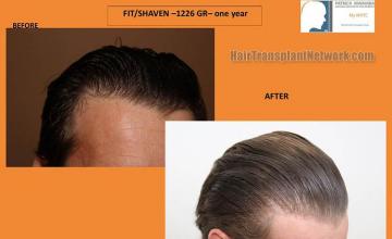 Hair transplantation surgery before and after images