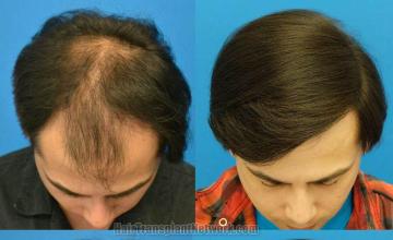 Top view - Before and after surgical hair replacement