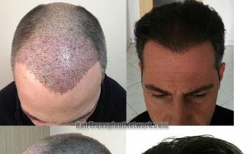 Hair restoration procedure before and after result photographs