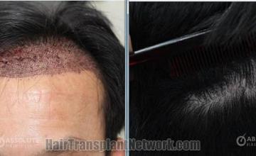 Surgical hair transplantation result photographs