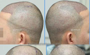 Hair replacement surgery before and after images