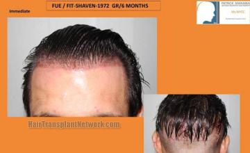 Hair restoration surgery before and after photos