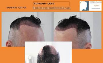 Hair restoration procedure before and after pictures