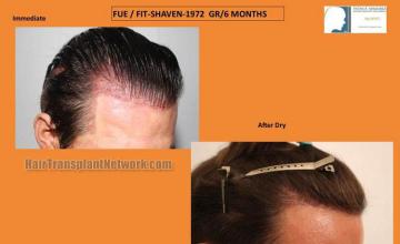 Hair transplantation surgery before and after photos