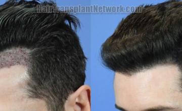 Before and after hair transplantation result photographs