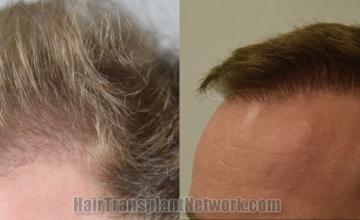 Before and after hair transplantation result photographs