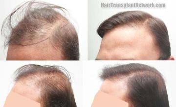 Hair transplantation surgery before and after photos