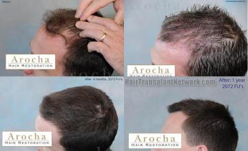 Hair transplantation surgery before and after pictures