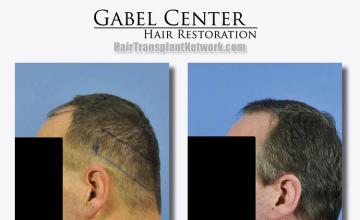 Hair transplantation surgery before and after images