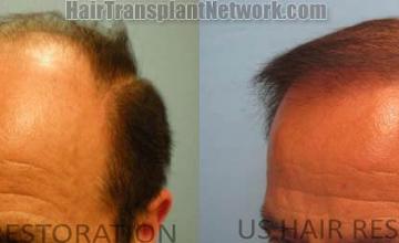 air transplantation surgery before and after images