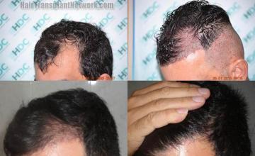 Hair transplantation surgery before and after pictures