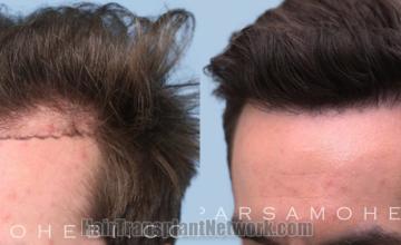 Before and after hair transplantation result photographs