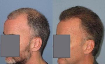 Hair transplantation surgery before and after pictures