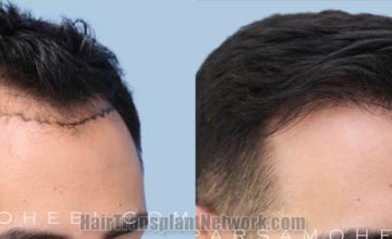 Before and after hair transplantation result photographs