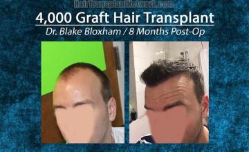 Hair transplantation surgery before and after pictures