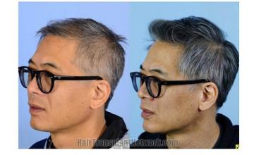 Hair restoration repair procedure before and after pictures