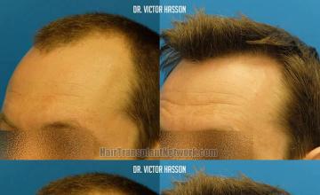 Hair restoration surgery before and after images