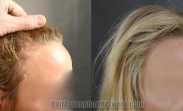 Before and after hair transplantation result photographs