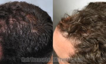 Before and after hair transplantation result photographs