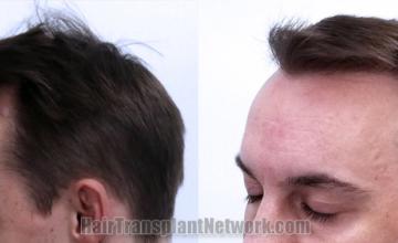 Before and after hair transplantation result photographs