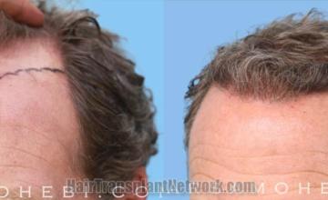 Before and after hair transplantation result photographs