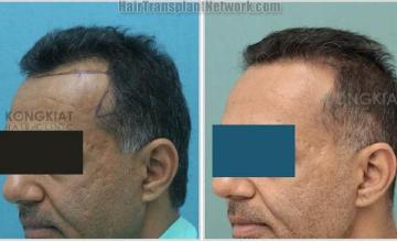 Hair transplantation surgery before and after photos