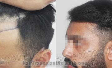 Before and after hair transplantation result photographs