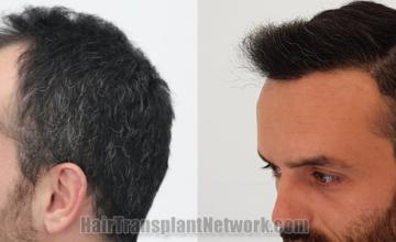 Before and after hair transplantation result photographs