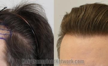 Before and after hair transplantation result photographs