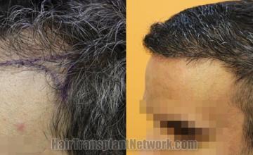 Before and after hair transplantation result photographs