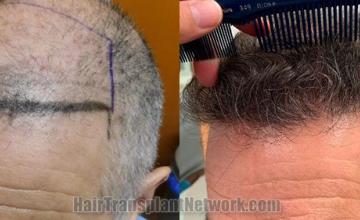 Before and after hair transplantation result photographs