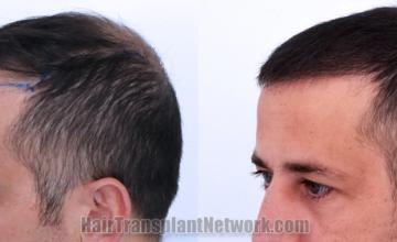 Before and after hair transplantation result photographs