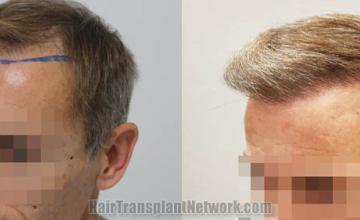 Before and after hair transplantation result photographs