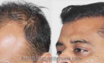 Hair restoration procedure before and after pictures