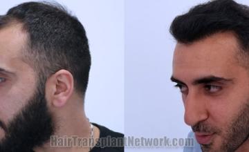 Before and after hair transplantation result photographs