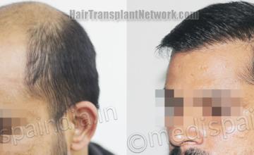 Before and after hair transplantation result photographs