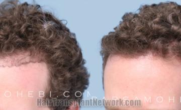 Before and after hair transplantation result photographs