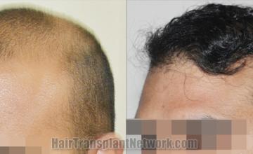 Before and after hair transplantation result photographs