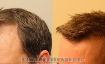 Before and after hair transplantation result photographs