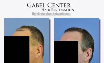 Hair restoration procedure before and after pictures