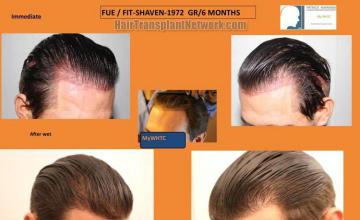 Hair transplantation surgery before and after images