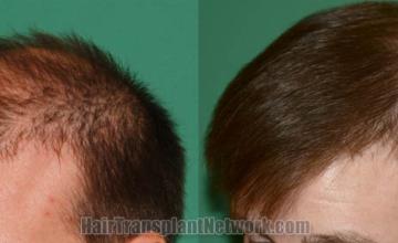 Hair restoration procedure before and after pictures