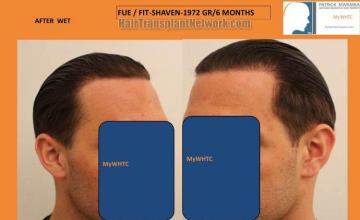 Hair transplantation surgery before and after photos