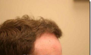 Hair restoration procedure results