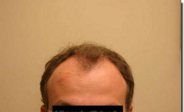 Hair restoration procedure results