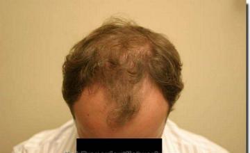 Hair restoration procedure results