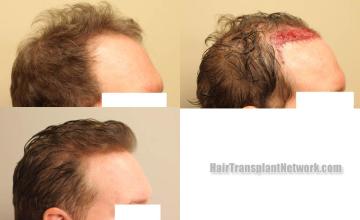 Hair transplantation procedure before and after results