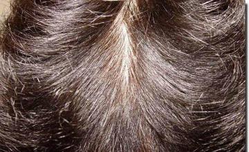 Hair restoration procedure results