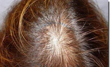 Hair restoration procedure results